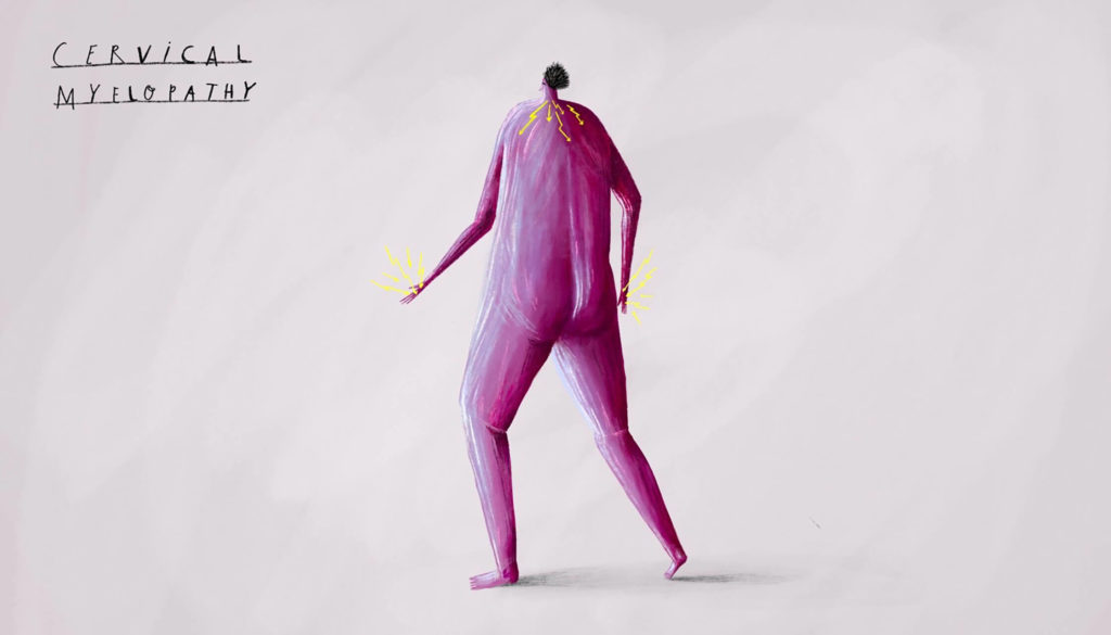 KOEF-cervical-myelopathy-neurosurgeon-brisbane-1024×585