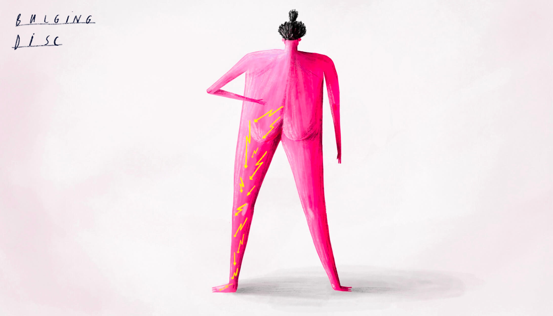 KOEF-bulging-disc-neurosurgeon-brisbane