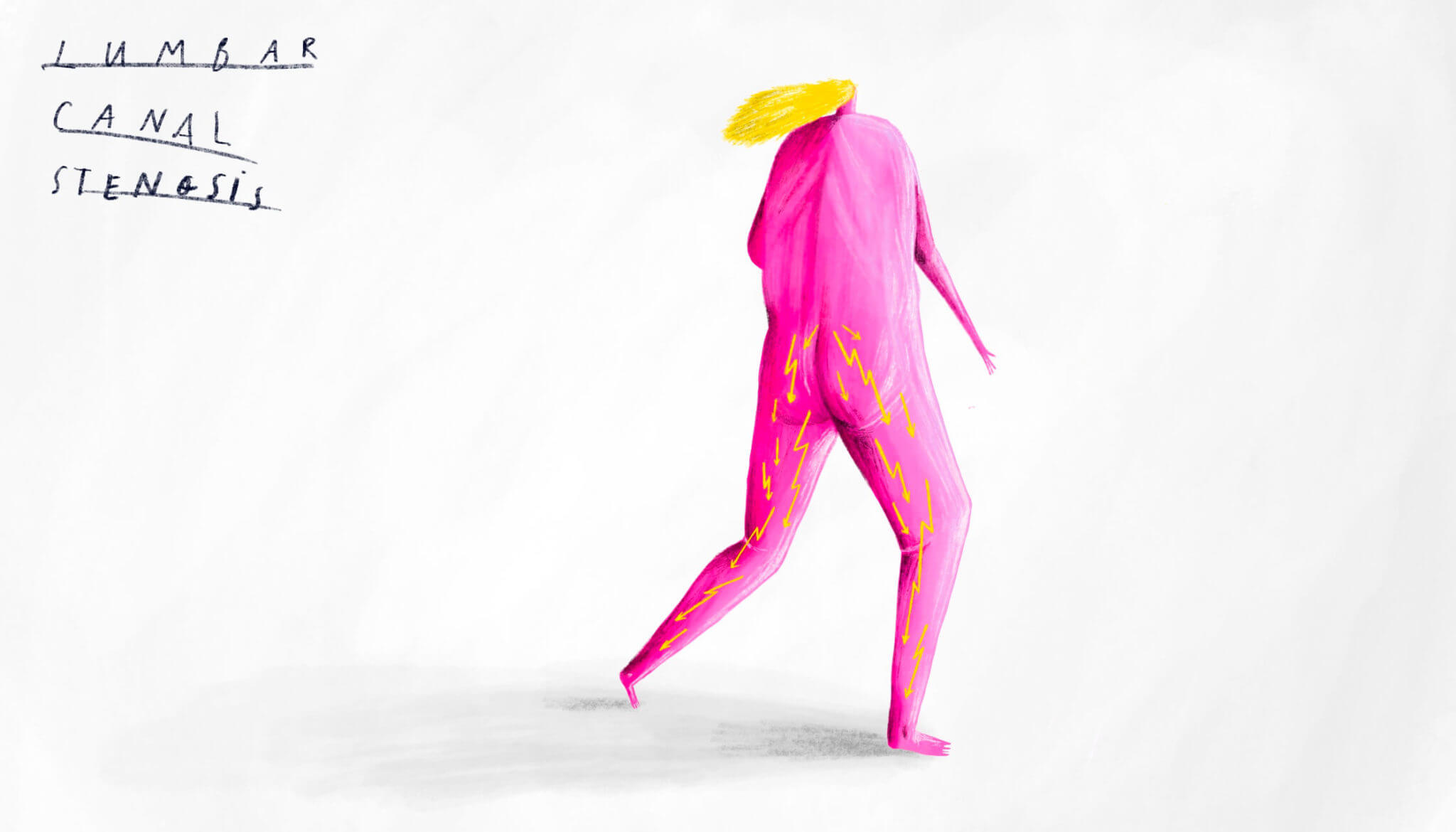 KOEF-lumbar-canal-stenosis-neurosurgeon-brisbane-2048×1170