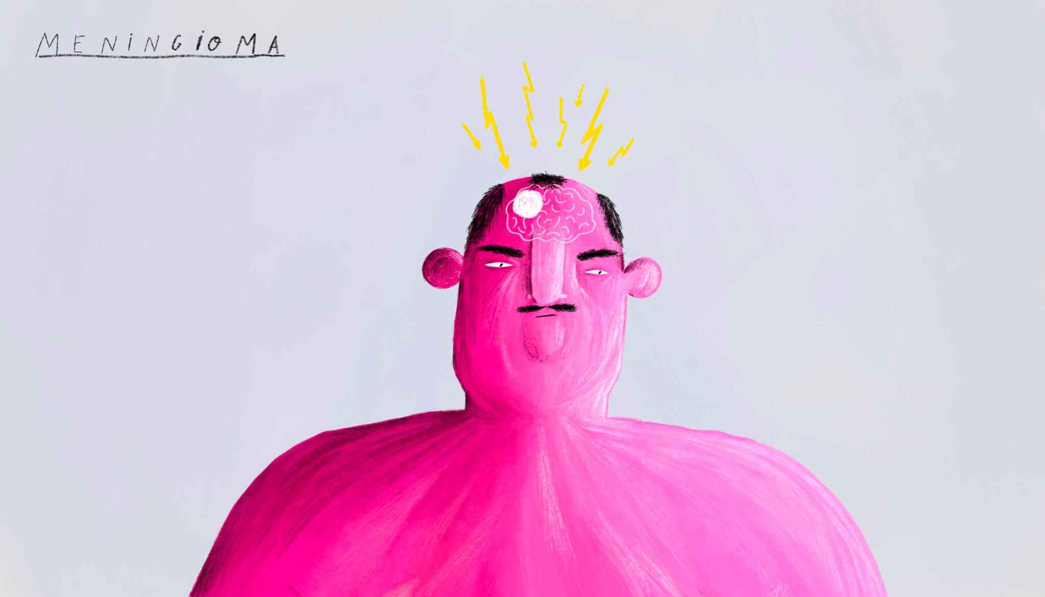 KOEF-meningioma-neurosurgeon-brisbane-2048×1170