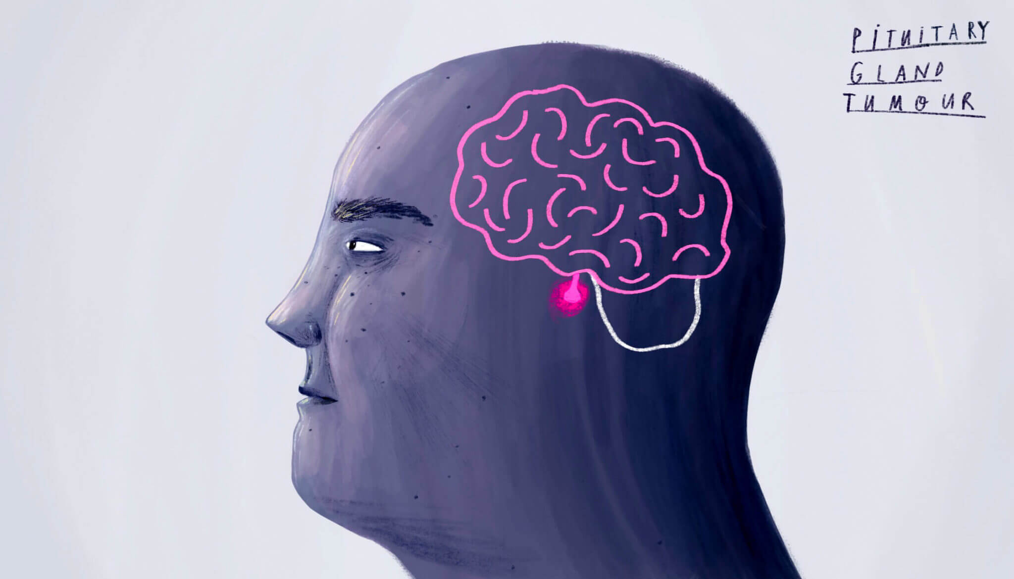 KOEF-pituitary-gland-tumour-neurosurgeon-brisbane-2048×1170