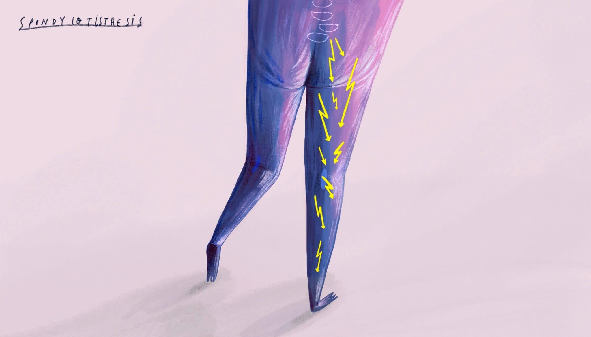 KOEF-spondylolisthesis-neurosurgeon-brisbane-2048×1170